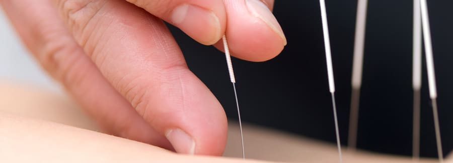 Acupuncture Treatment Therapy