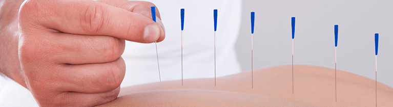 Acupuncture-Treatment-Orangeville2 Sciatic Nerve Pain Treatment