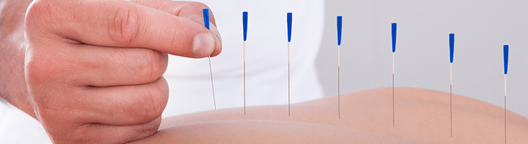 Acupuncture Treatment