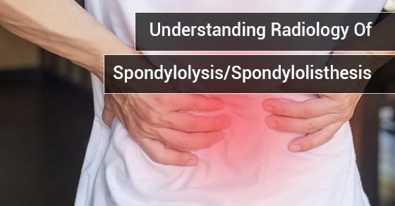 Understanding Radiology Of Spondylolysis/Spondylolisthesis