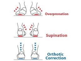 custom orthotics for overpronation